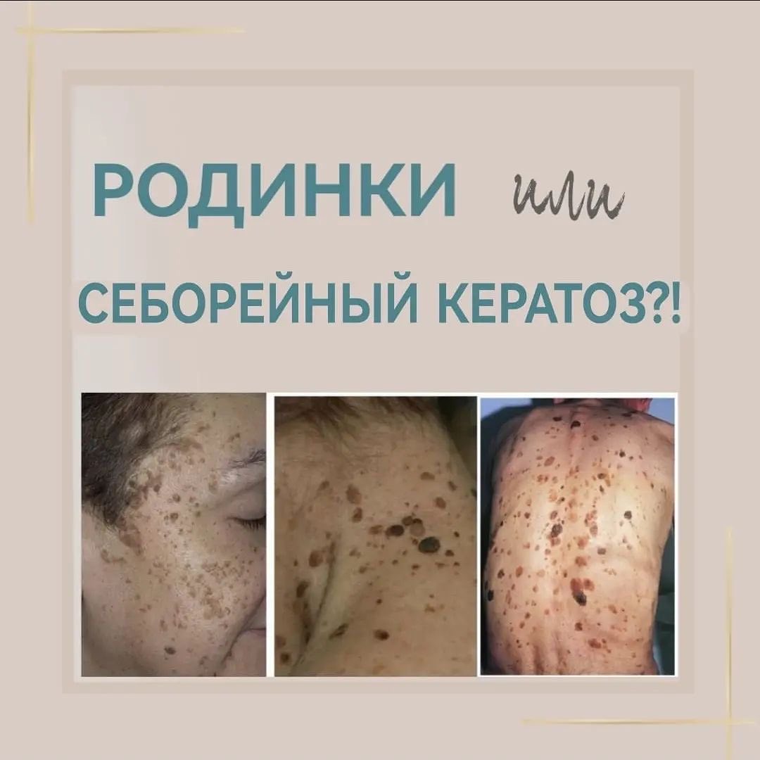 Себорейный кератоз или родинки? | Uniserv Medical Center